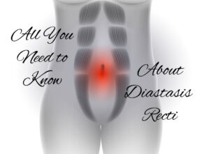 All You Need to Know About Diastasis Recti