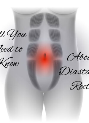 Diastasis-Recti