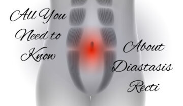 All You Need to Know About Diastasis Recti