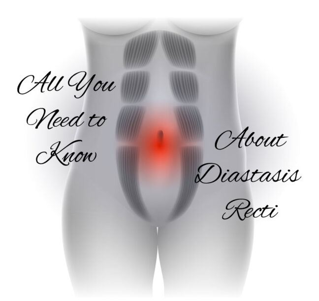 All You Need to Know About Diastasis Recti