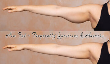 Arm Fat – Frequently Questions & Answers