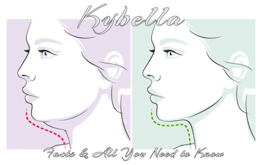 Kybella – Facts & All You Need to Know