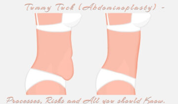 Tummy Tuck (Abdominoplasty) – Processes, Risks and All you should Know.