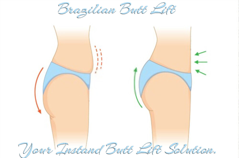 Brazillian-Butt-Lift