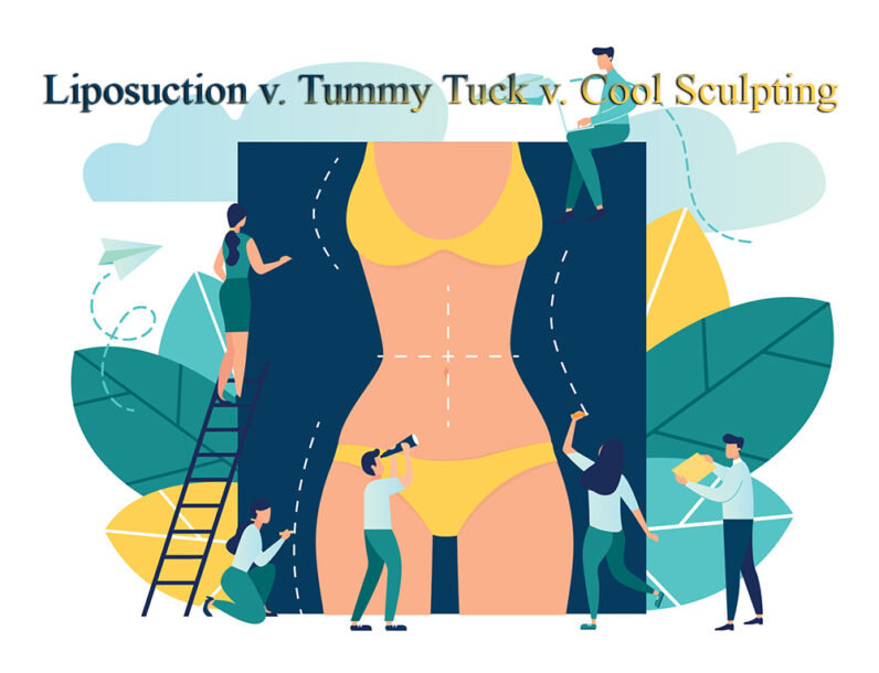Liposuction v. Tummy Tuck v. Cool Sculpting