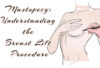 Mastopexy-Breast-Lift-