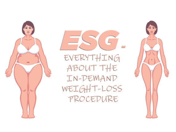 ESG-Endoscopic Sleeve Gastroplasty